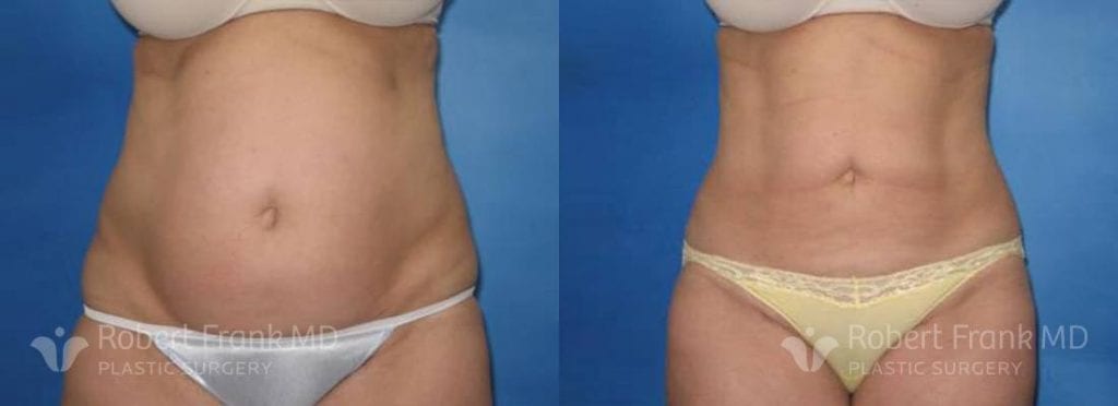 Liposuction before and after patient | robert frank md